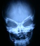 Figura 7: RX de cráneo de una braquicefalia