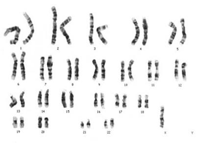 Resultado de imagen para anomalias cromosomicas