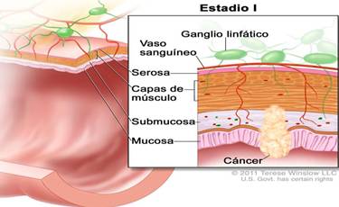 cancer colon ganglios afectados