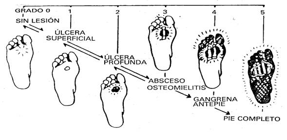 Resultado de imagen para Tipos de pie diabético