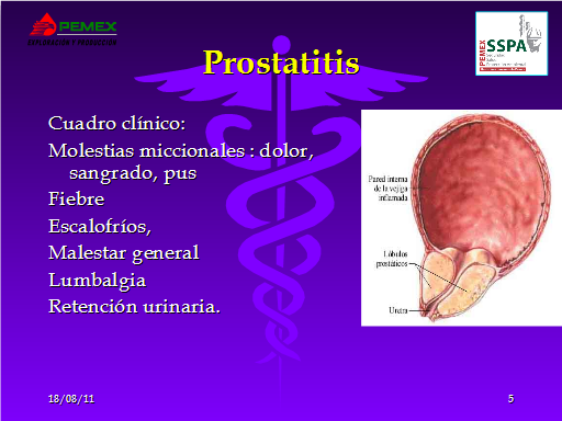Cancer prostata sintomas iniciales