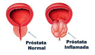 crecimiento de las células de la próstata