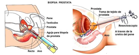 prostata preventiva