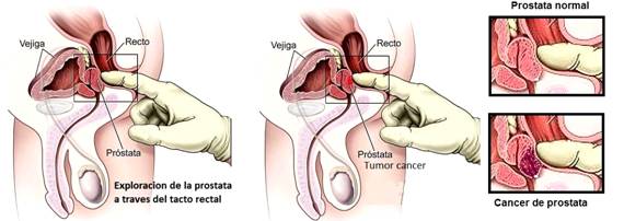 cancer de prostata medidas de prevencion)
