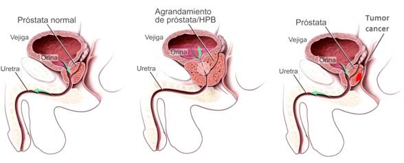 Cancer de prostata pronostico, Cand sfarsitul vietii in cancerul de prostata vine etapa 4