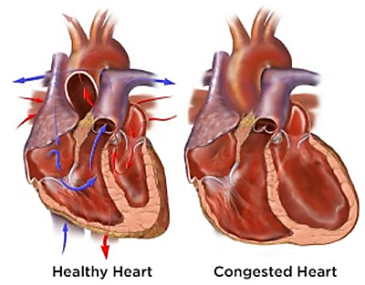 insuficienta cardiaca congestiva norma este simplă din prostatită