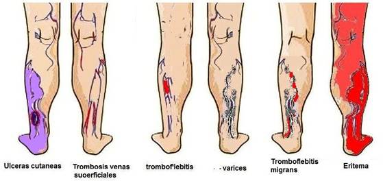 Cum să identificați varicoza sau tromboza, Diferena de varicoza din tromboza